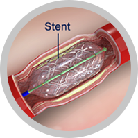 Cardiac Catheterization